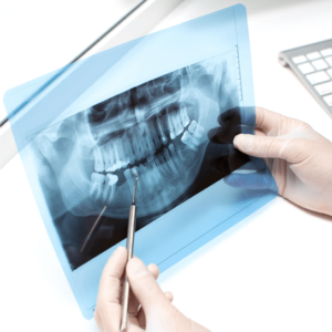 Dental OPG X-Ray