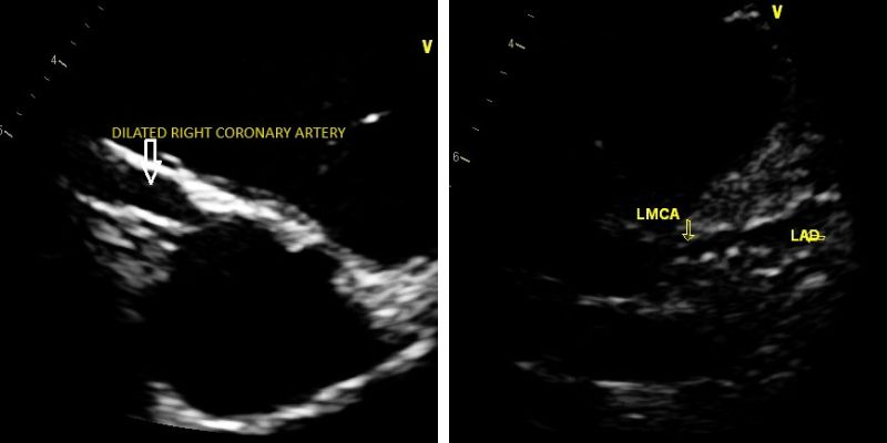 Cardiac findings in multisystem inflammatory syndrome in children