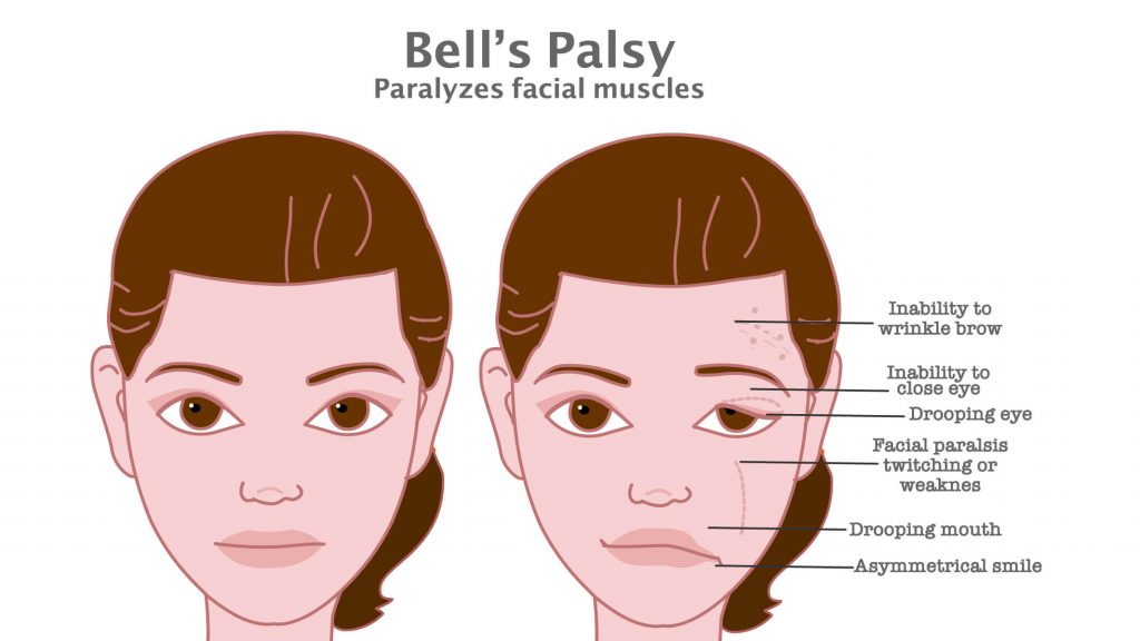 bells palsy