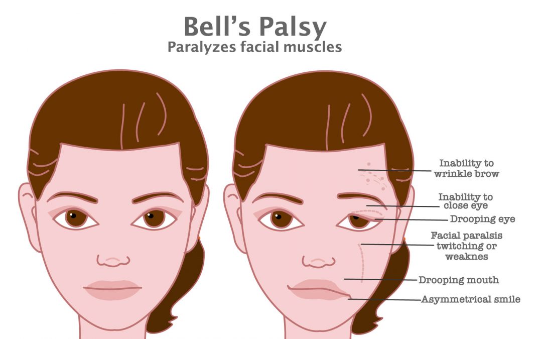 bells palsy