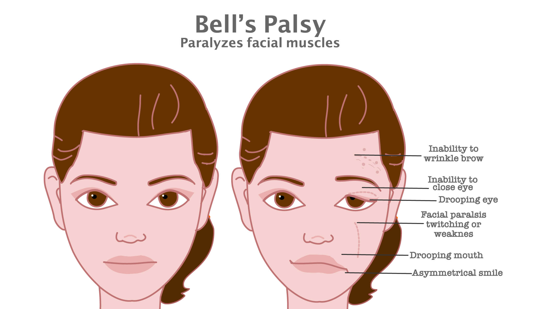 Bell’s Palsy: Understanding Facial Muscle Weakness and Role of Physiotherapy