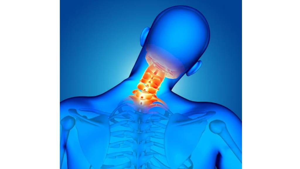 cervical spondylosis