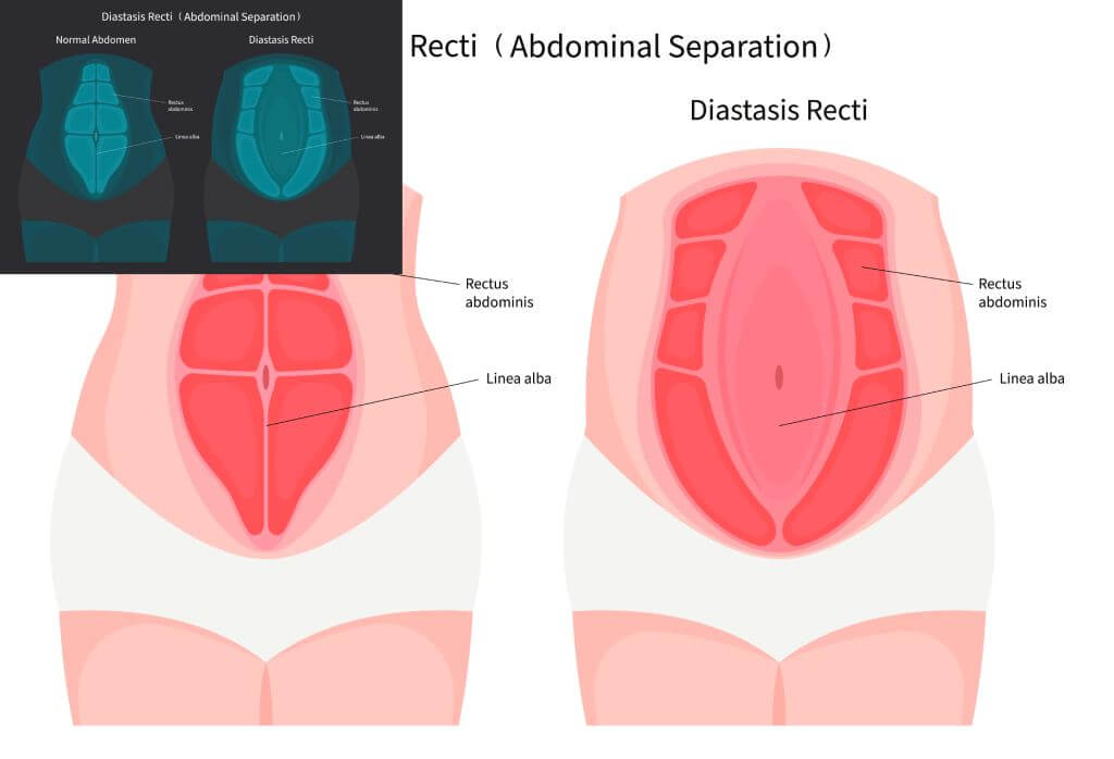 Diastasis Recti: Commonly Seen in New Mothers and How a Physiotherapist Can Help