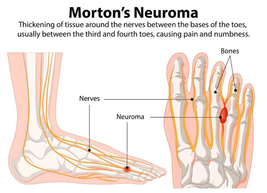 Morton’s Neuroma & The Role of Physiotherapy
