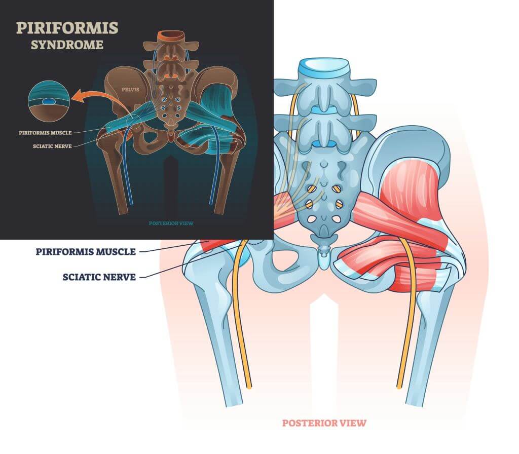 Piriformis Syndrome & Piriformis Tightness: A Physiotherapy Approach